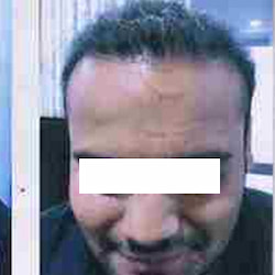 after-2-hair-transplant