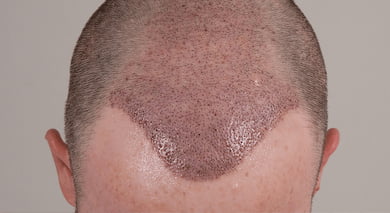 Precautions  After A Hair Transplant