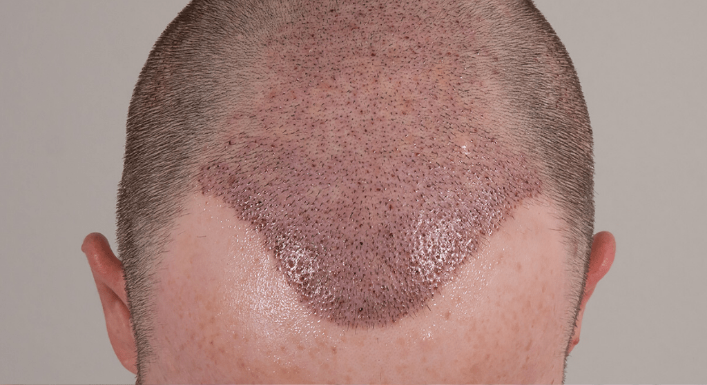 Hair Transplant