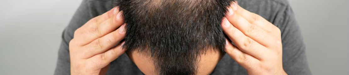 fue hair transplant