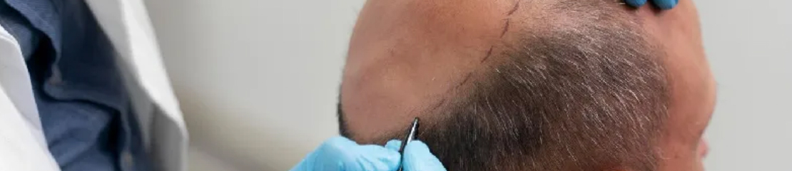 fue hair transplant