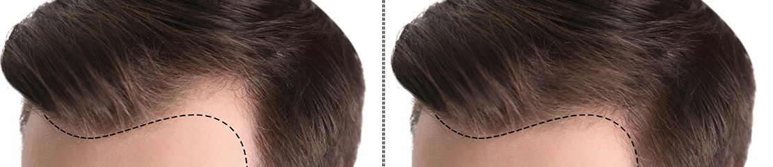 fue hair transplant