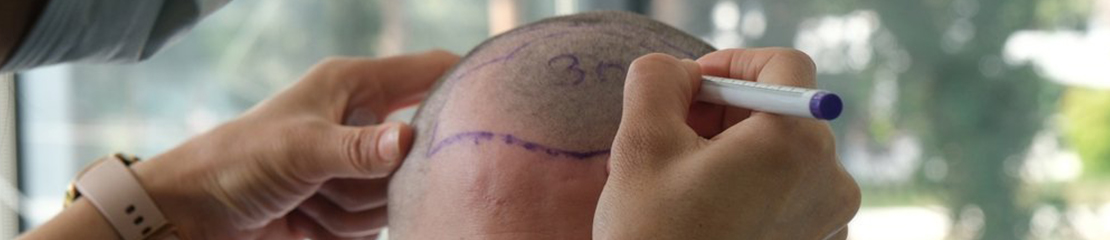 fue hair transplant