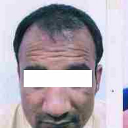 before-1-hair-transplant