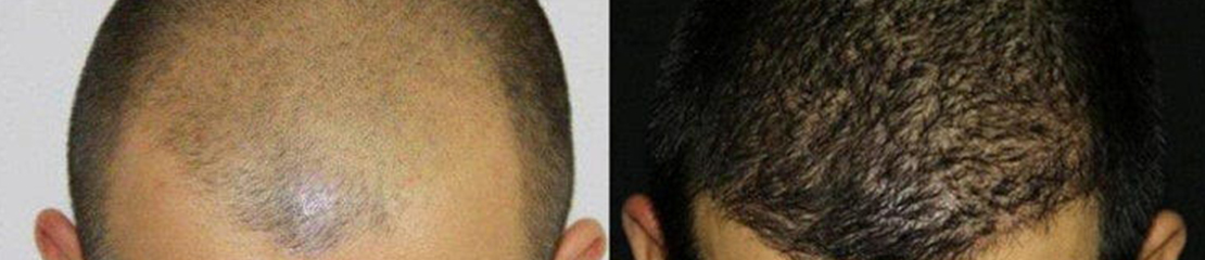 fue hair transplant